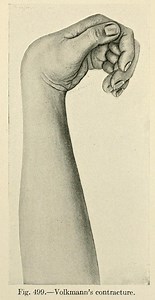 Volkmann's contracture - Alchetron, the free social encyclopedia