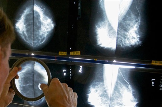 Mammograms can reveal risk for heart disease