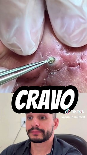 Os cravos, também conhecidos como comedões, são uma condição comum da pele em que os poros ficam entupidos com sebo (óleo) e células mortas da pele. Eles aparecem como pequenos pontos escuros ou brancos na superfície da pele e geralmente se formam na zona T do rosto (testa, nariz e queixo), embora possam ocorrer em outras áreas do corpo também. Os cravos pretos são abertos e expostos ao ar, o que faz com que o sebo oxidado fique escuro, dando-lhes uma aparência escura. Já os cravos brancos são f