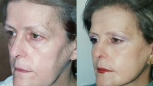 Removing and Adding Fat Are Both Great Lower Eyelid Options