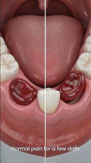 Pain After Tooth Extraction What's Normal and When Should You Worry