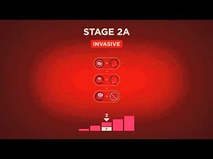 Beyond The Shock - Chapter 5 - Types & Stages - Stage 2 Breast Cancer