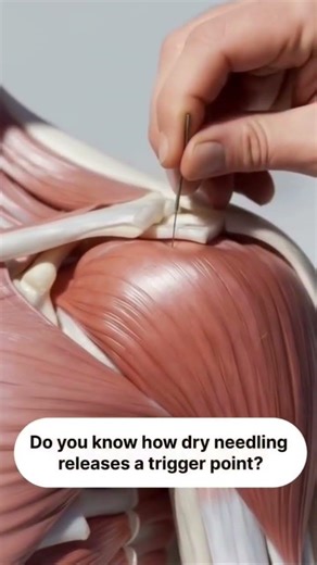 Dry Needling 🪡is more than just inserting a needle #viral #medical #ytviral #student #medicalstudent