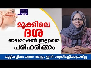 മൂക്കിലെ ദശ ഓപ്പറേഷൻ ഇല്ലാതെ പരിഹരിക്കാം \\ mookil dasha malayalam \\ nasal polyps home remedy