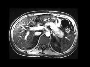 Autoimmune pancreatitis