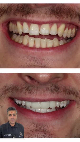 I love helping our patients feel confident and proud of their smiles, and we hope this video inspires you to take the first step towards your own smile makeover. #smilewithconfidence #smiletransformation #cosmeticdentistry #veneers #teethwhitening #beforeandafter #confidenceboost #compositebondinguk #dentistleicester