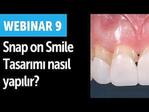 Dental Webinar 9 - Exocad ile Snap on Smile tasarımı nasıl yapılır?