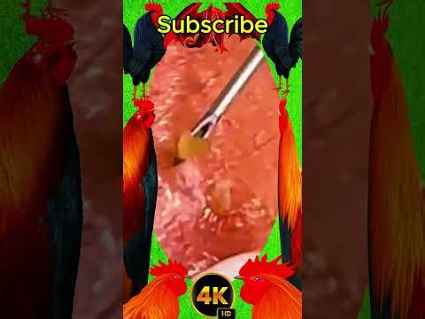 Blackheads Removal #286 | Acne Treatment and Very Satisfying Satisfying Pimple pop #blackheads