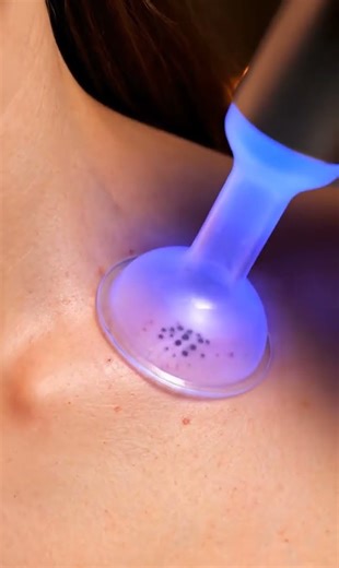 Gentle Collarbone Blackhead ASMR#asmr #skincare #macroasmr #satisfying #beauty #asmr #asmrskincare