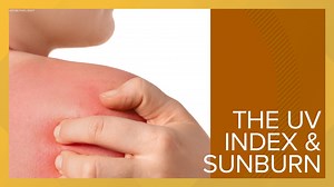 The UV Index and Sunburn