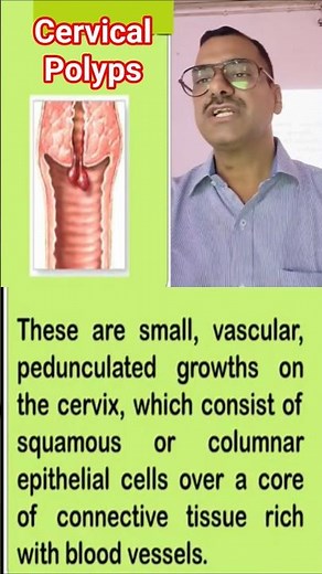 cervical polyps #midwifery