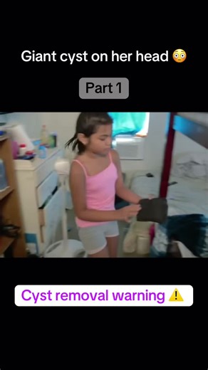 Giant cyst on her head 😳 #satusfyingvideos #drpimplepopper #cystremoval #skincareroutine #acnetreatment #blackheadsremoval