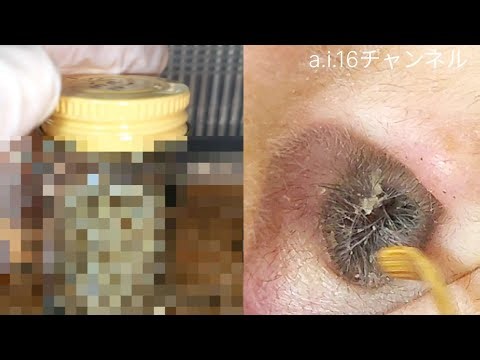 【耳掃除】#158 〜強風で耳主の〇〇が飛ぶw？2年間溜めた耳垢〜 earwax
