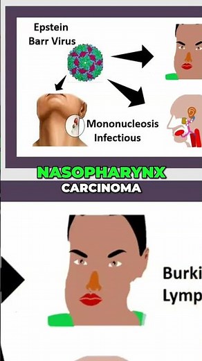 Burkitt's Lymphoma: Causes, Diagnosis, and Treatment #shorts