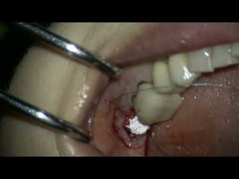 250902 RFT socket preservation