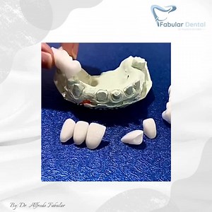 24K views · 410 reactions | What are the benefits of Zirconia Crowns?...