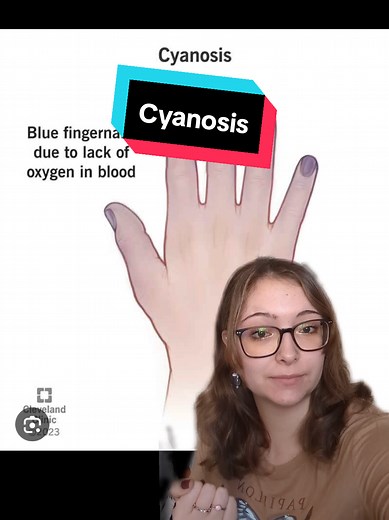 Understanding Cyanosis: Causes and Effects on Health