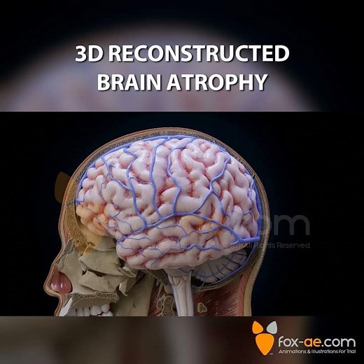Brain Atrophy