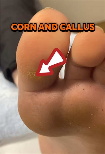Effective Treatment for Painful Corns on the Big Toe
