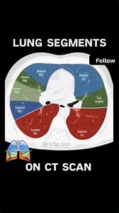 Lung Segments CT axial view.. #radiology_technique #radiologist #post #mbbsstudent #pulmonary #fbyシvideo #fbreelsvideo #radiographer #radiology #angiography #MBBS #pulmonologist #pulmonology | Diwakar Patel