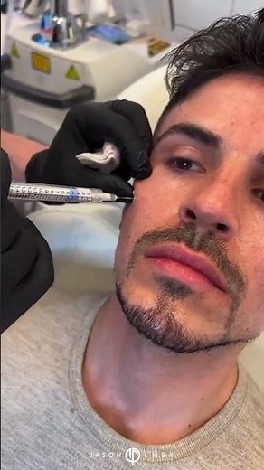 #shorts MALE FACIAL SCULPTING WITH FILLERS | Dr. Jason Emer