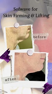 339 reactions · 37 shares | Sofwave is the latest technology for Skin...