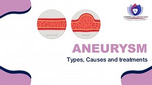 Aneurysm: Types, causes & treatment - SlideServe