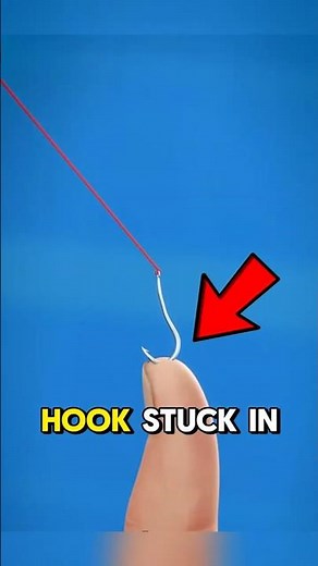 How to Remove a Fish Hook From Your Finger!😱