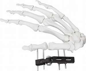 [Hot Item] External Fixator Hand Bone Pin Stent Radius Mini Fixator Medical Equipment