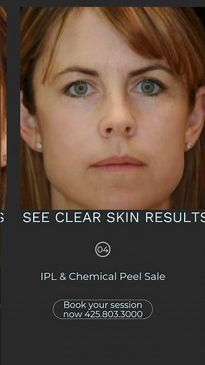 See clear skin results with IPL