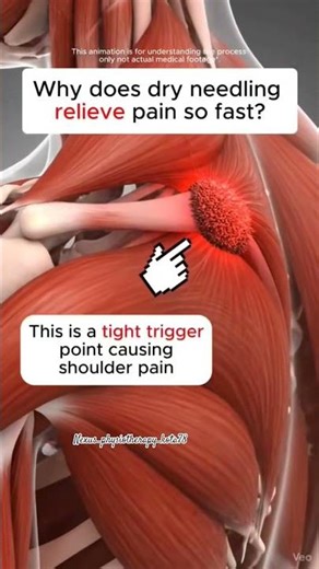 MFR techniques for Trigger point | Trigger point release technique #anatomy #physiotherapist