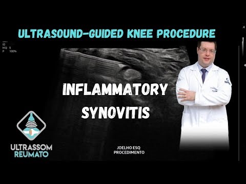 Ultrasound-Guided Procedure in Knee Inflammatory Synovitis