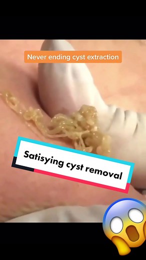 Never ending cyst extraction. #cystpopping #cystexplosion #whiteheadremoval #whiteheadextractions #blackheadsremoval #dilatedpore #weirdlysatisfying
