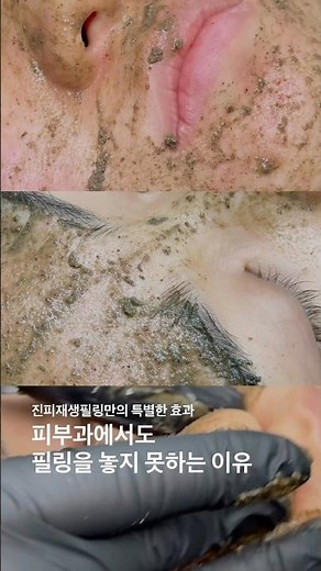 피부과에서도 필링을 놓지 못하는 이유 #대구피부관리 #필링 #여드름 #skincare