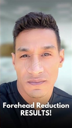 From High Forehead to Balanced Look in Just a Few Hours | Forehead Reduction Before & After
