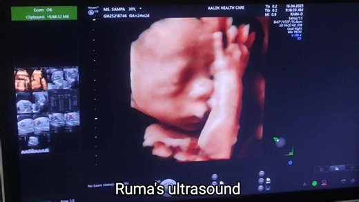Realtime Scan (4D Anomaly scan) এই এনোমালি স্ক্যানটি ২৪ সপ্তাহ ২ দিনের সময় করা হয়েছে। এনোমালি স্ক্যান ১৮-২৪ সপ্তাহে করা উচিত। বেবিটি সম্পূর্ণরূপে সুস্থ আছে। সবাই ওর জন্য দোয়া করবেন। #fetal #anomalyscan | Ruma's Ultrasound