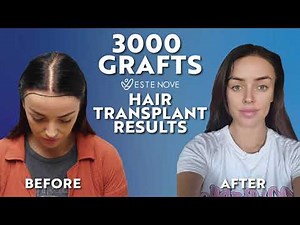 Female Hair Transplant in Turkey | Rachel's New Hair | Before and After