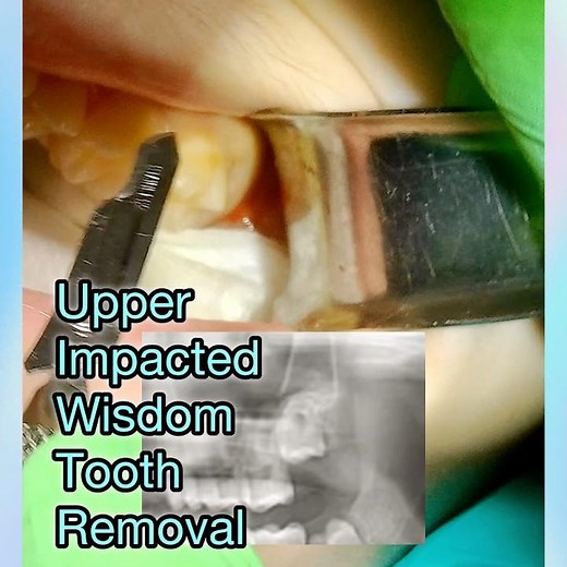 Upper Wisdom Tooth Extraction: The Elevator Technique Revealed #Shorts