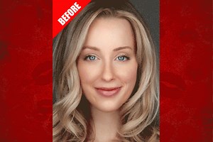 This surgery fixes ‘resting bitch face’ in an hour — patients can’t stop smiling about it