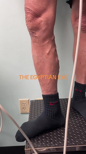 OPTIMA VEIN CARE on TikTok