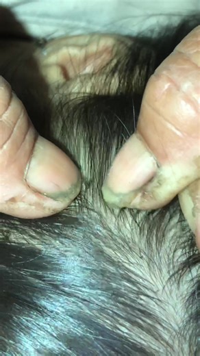 Effective Lice Removal Techniques Explained