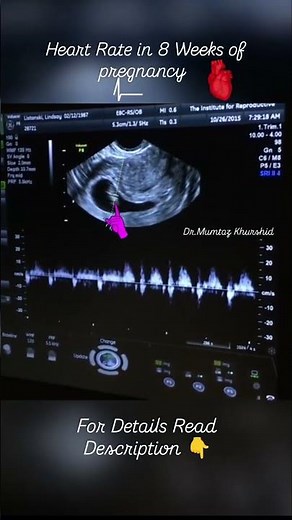 8 Weeks Pregnancy Baby Heart Rate seen On Ultrasound Scan