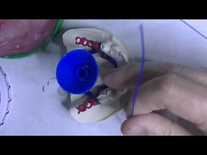 3. Colocación de bebederos en un esquelético inferior de prótesis mixta