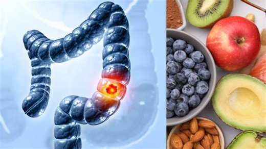La dieta para personas en tratamiento de cáncer de colon revela secretos para evitarlo y mejorar la alimentación