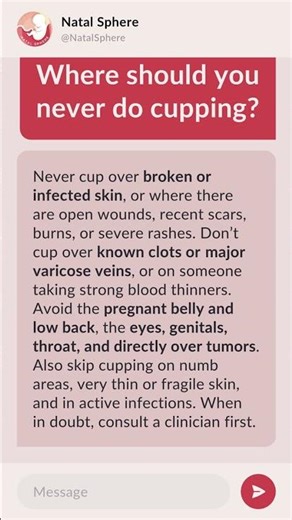 Where should you never do cupping?