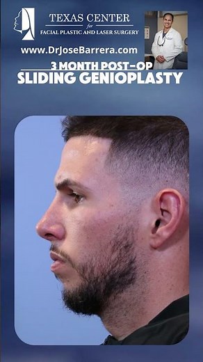 3 months post-op following a Sliding Genioplasty procedure.