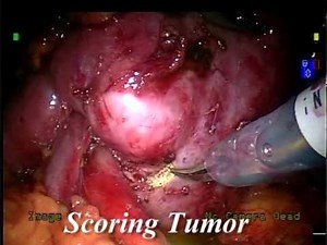 Renal Cancer - Partial Nephrectomy With Robot Assistance • Video • MEDtube.net