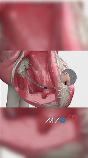How are device leads attached to the heart?