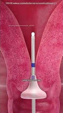 Hysteroscopy Procedure (3D Animation)#hysteroscopy #hysteroscopysurgery #hysteroscopyprocess