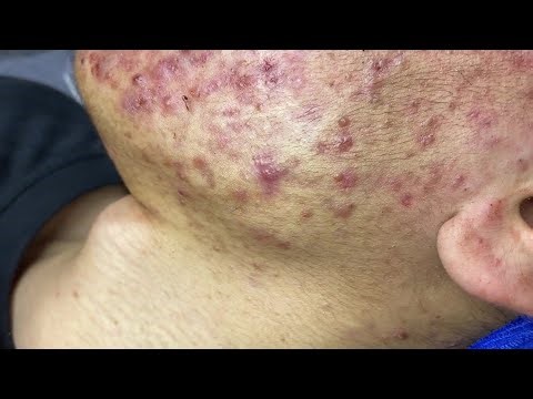 Satisfying Blackhead & Whitehead Removal | Severe Acne Treatment